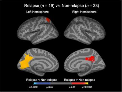 Increased brain gyrification and subsequent relapse in patients with first-episode schizophrenia